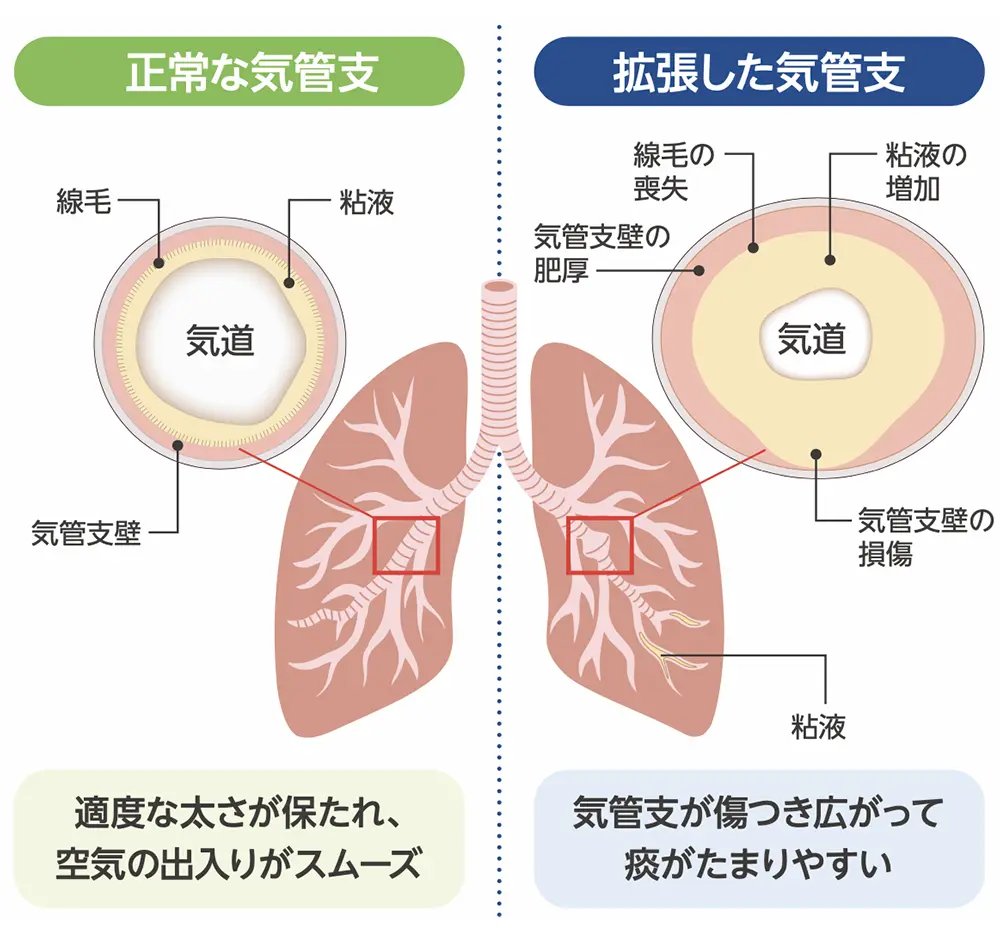 気管支拡張症の肺で起きていることのイメージ。正常な肺と気管支拡張症の肺との比較。正常な肺は適度な気道の太さが保たれ、空気の出入りがスムーズな一方、気管支拡張症の肺は気管支が傷つき広がって痰がたまりやすい。